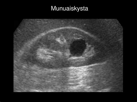 Rintarauhasten ultraäänitutkimus